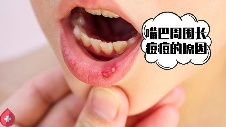 长痘可以吃什么 长痘吃什么食物好