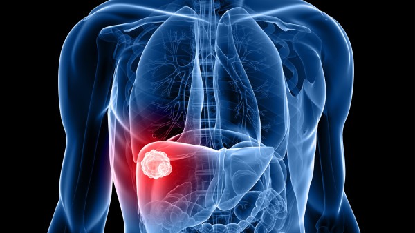 哪些肝癌患者不适合放疗 这4类肝癌患者不推荐做放疗