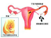 膀胱子宫内膜异位症