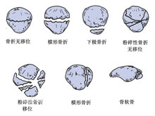 髌骨骨折