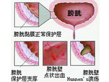 膀胱炎
