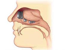 鼻腔良性肿瘤