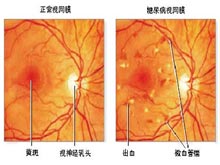2型糖尿病性视网膜病变