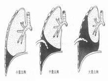 创伤性血胸