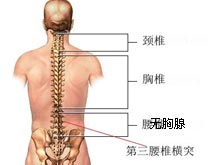 第三腰椎横突综合征