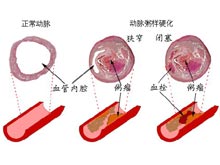 动脉粥样硬化