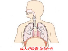 成人呼吸窘迫综合征