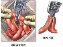 短肠综合症