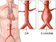 动脉瘤