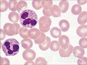 成人T细胞白血病