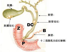 胆总管结石