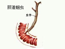 症预防饮食胆道蛔虫病(biliaryascariasis)蛔虫从小肠逆行进入胆道