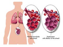 肺氣腫