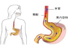 反流性食管炎