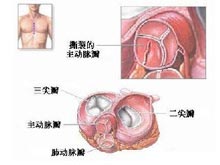 风湿热