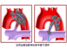 动脉导管未闭