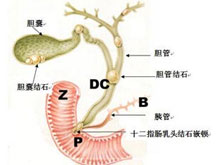 胆石性肠梗阻
