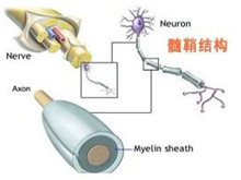 多灶性运动神经病