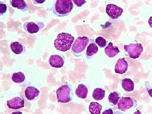 单核细胞白血病
