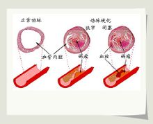 结节性多动脉炎