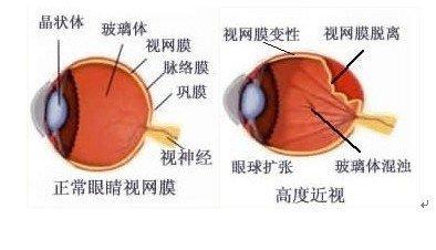 巩膜葡萄肿