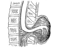 脊膜脊髓膨出