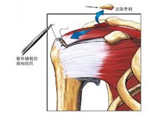 肩袖肌腱损伤