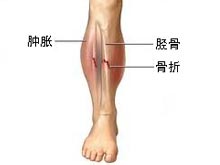 胫骨骨折病因症状 胫骨骨折诊断治疗 饮食保健 复禾健康