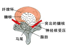 脊髓炎