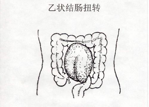 结肠扭转是指由于移动结肠,横结肠过长,乙状结肠冗长等工作段沿其系膜