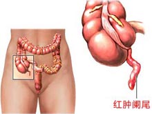 阑尾炎