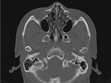 颞骨骨折