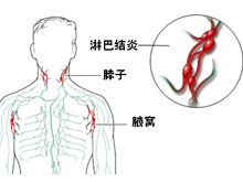 淋巴结炎