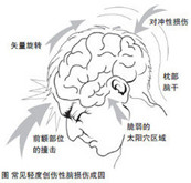 脑震荡