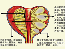 肉芽肿性前列腺炎