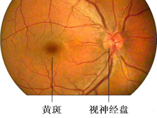 缺血性视神经病变