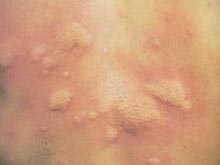 慢性荨麻疹