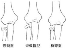 桡骨颈骨折
