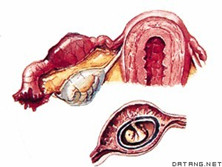 輸卵管妊娠