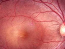 视网膜静脉阻塞