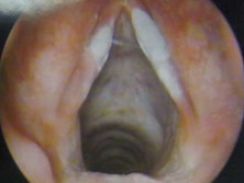 得了喉结核的咽喉图片图片
