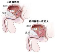 前列腺增生