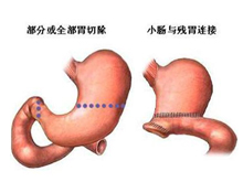 倾倒综合症