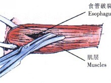 食管破裂