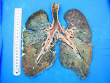 石棉肺