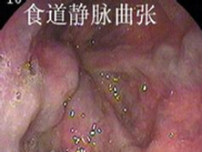 食管静脉曲张