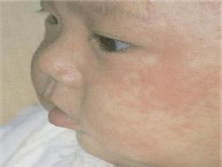先天性风疹综合征