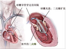 先天性二尖瓣畸形