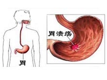 胃潰瘍