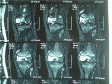 膝关节滑膜皱襞综合征